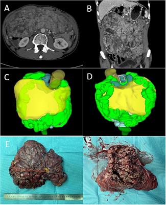 Primary extra-gastrointestinal stromal tumor of retroperitoneum: Clinicopathologic characteristics and prognosis of six cases